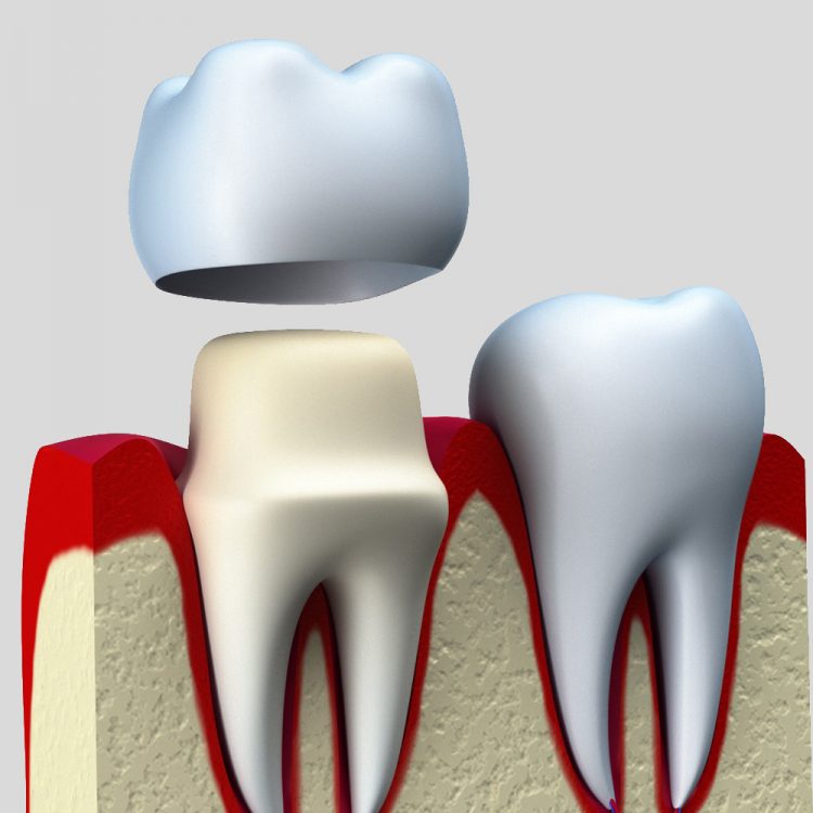 Banner image of Crowns and Bridges Process