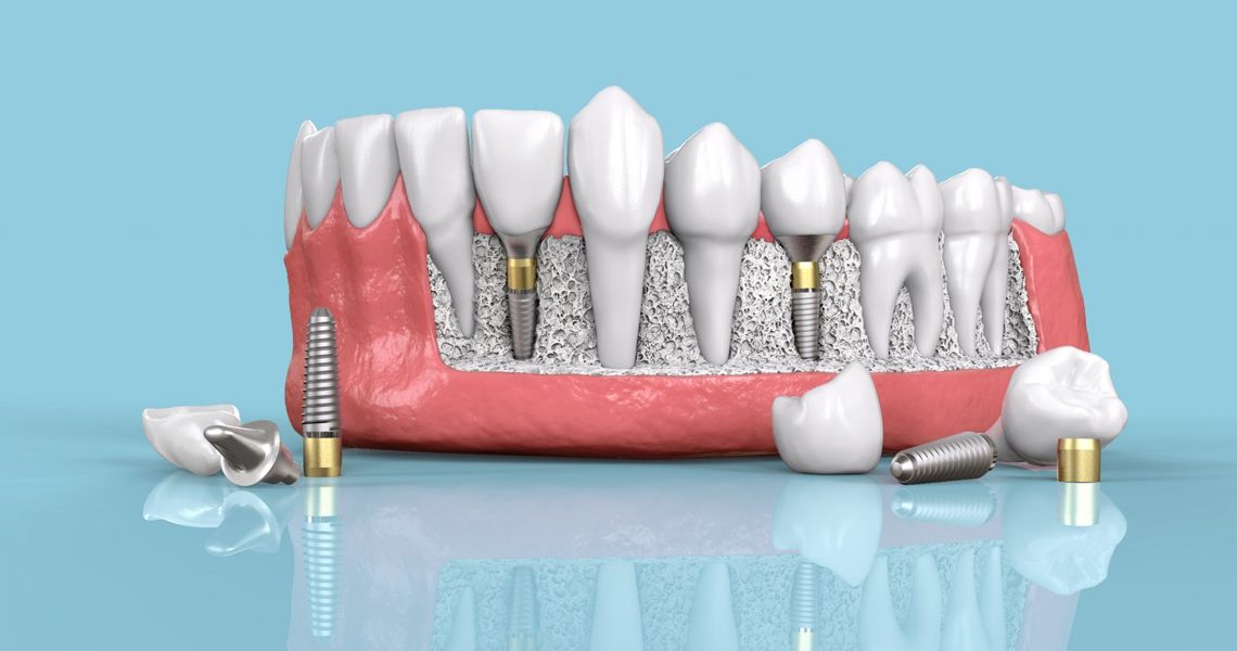 Dental Implant Components Explained