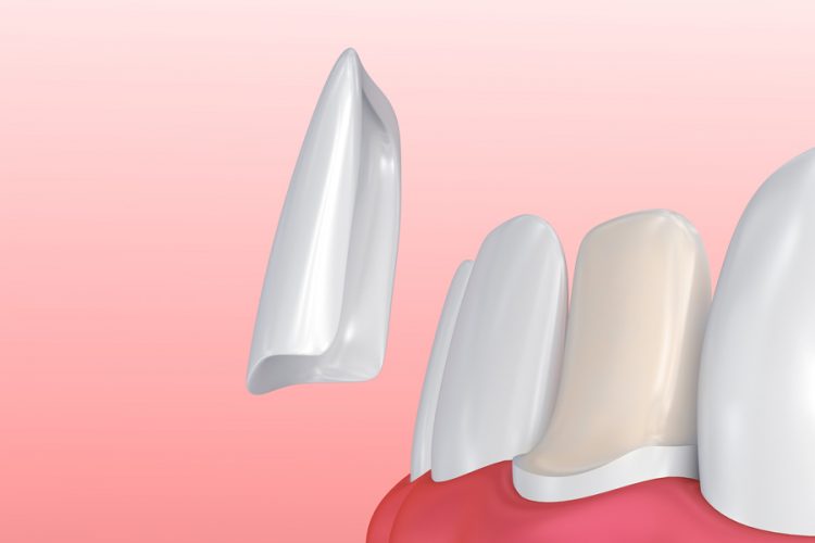 The Different Steps Involved In Applying Dental Veneers
