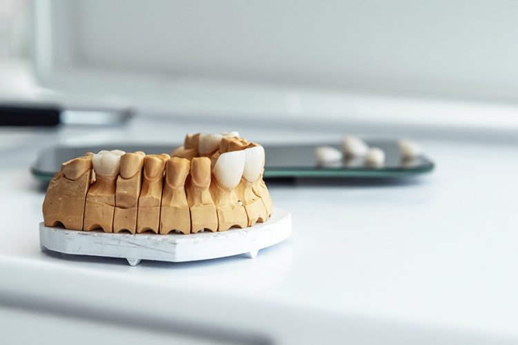 implant and dental crown