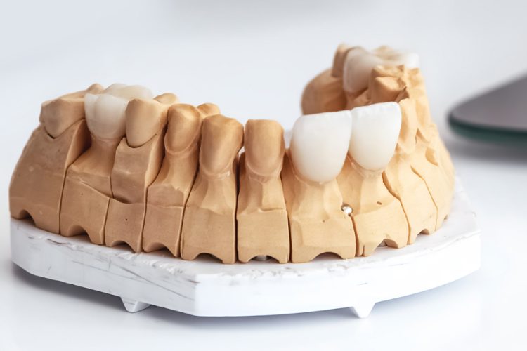 How Veneers and Laminates Can Boost Your Confidence in Temecula, CA?